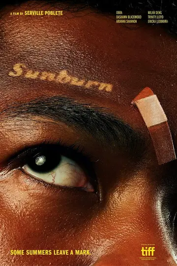Sunburn